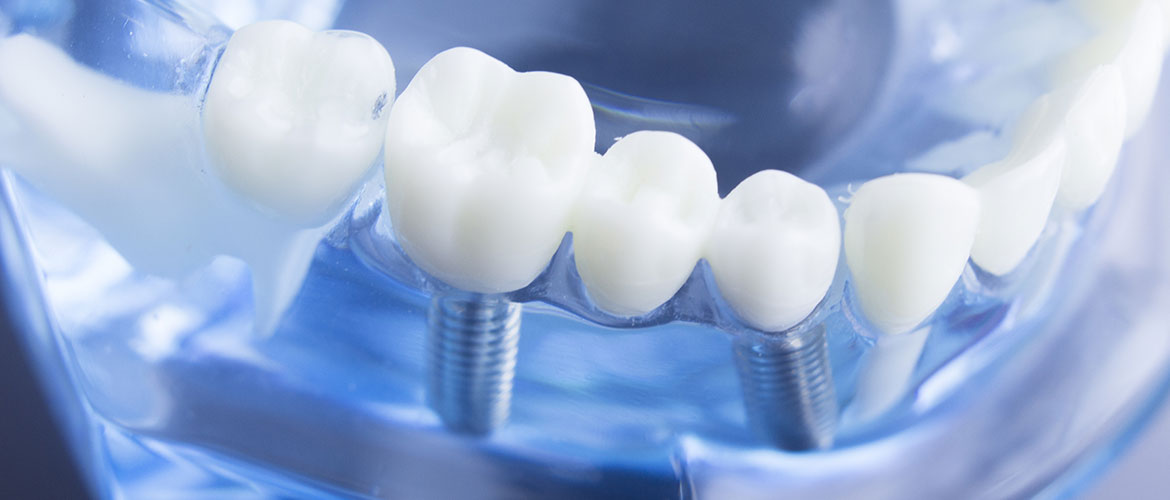 Zahn­implantate für festen Zahnersatz in Moers